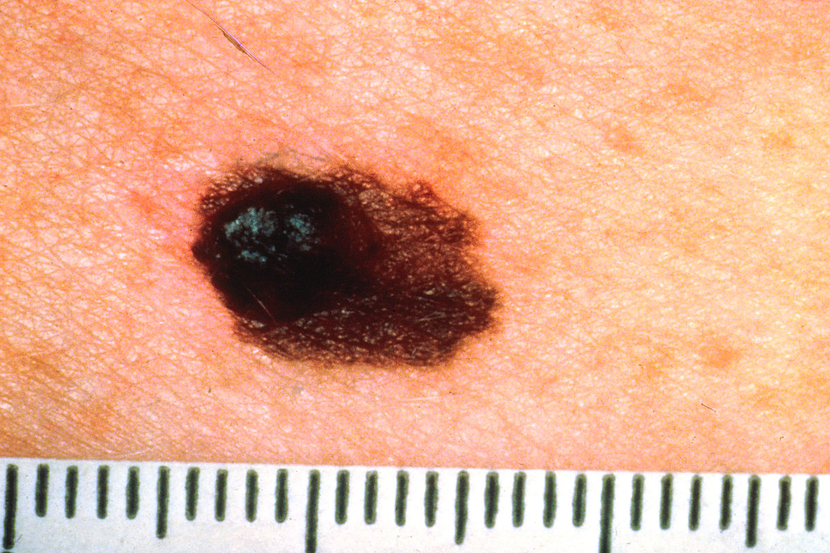 Asymmetrical_melanoma